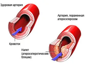 периферна артериална болест причини, симптоми, лечение, диагностика и профилактика