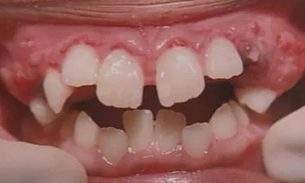 Младите периодонтит (desmodontoz или пародонтоза) - Енциклопедия на стоматология