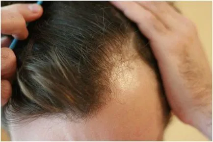 Hátráló hajszálrepedés férfiaknál hátráló hajszálrepedés a homlokon, amikor a férfi kezdett az utóbbi időben, hogy megakadályozza ezt a folyamatot