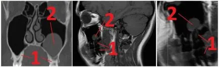 Mri стойност при диагностицирането на патологии синусите