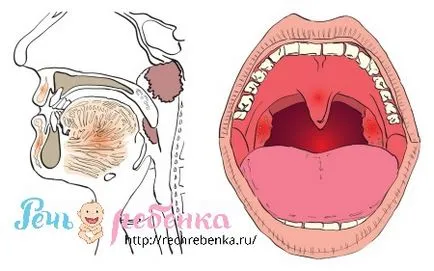 Аденоиди и речта на детето, речта на детето