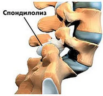 Anomaliile cauze ale coloanei vertebrale, simptome, tratament