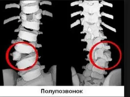 Аномалии на гръбначния стълб причини, симптоми, лечение