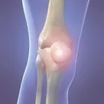 necroza aseptica a articulației genunchiului - cauze si simptome