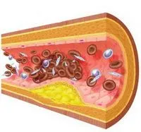 Ateroscleroza - tratamentul homeopatiei, marturii pacient, Aconit-gomeomed