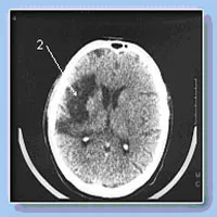 Мозъчна склероза причини за заболяването и методи за лечение в клиники мрежа капитал