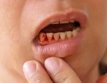 Атрофичен гингивит причинява, развитие и лечение на заболяване на венците