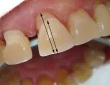 Atrófiás gingivitis okoz, fejlesztése és kezelése ínybetegségek