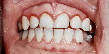 Atrófiás gingivitis okoz, fejlesztése és kezelése ínybetegségek