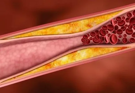 ateroscleroză cerebrală cauze, simptome și tratament