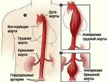 Hasi aorta - aneurizma