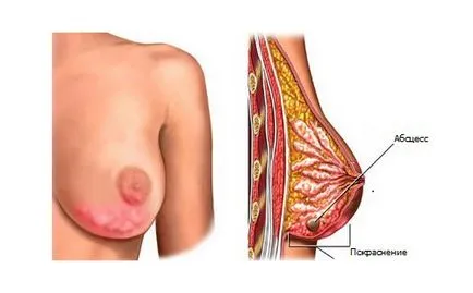 Възпалено гърдите хранене причини, лечение и профилактика