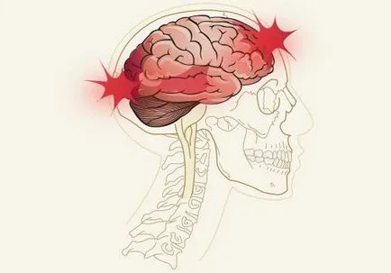 Traumás agysérülés elsősegély, a tünetek, jelek