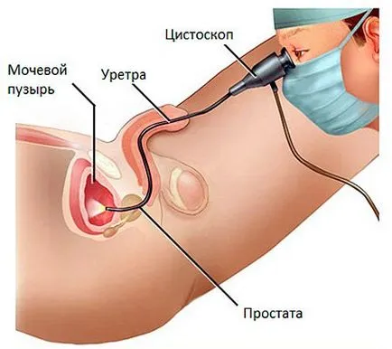 Cystoscopy се извършва и когато и двете показва как