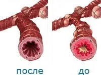 Устройство за неинвазивни vozdestviya астероиди - да купят устройство за неинвазивно vozdestviya