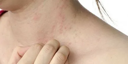 Dermatitis terhesség - okainak, a tünetek, a kezelés és a magzatra