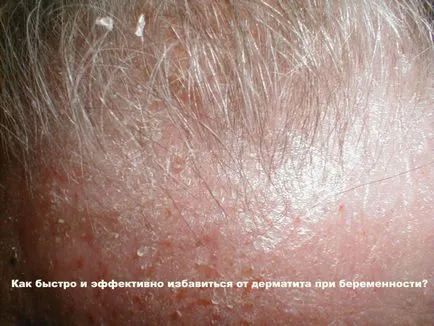 Dermatitis terhesség a megfelelő kezelést, és a hatása a magzatra