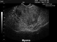Diagnózis mióma ultrahang - a részleteket a vizsgálat