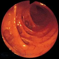 diverticulită de colon - cauze, simptome, diagnostic și tratament