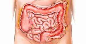 Simptomele diverticuloza si tratamentul bolii diverticulara a colonului