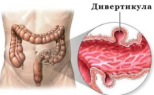 Дивертикулоза симптоми и лечение на дивертикулит на дебелото черво