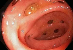 Simptomele diverticuloza si tratamentul bolii diverticulara a colonului