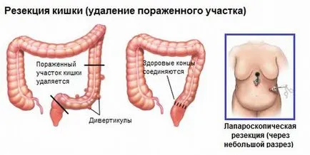 Дивертикулоза симптоми и лечение на дивертикулит на дебелото черво