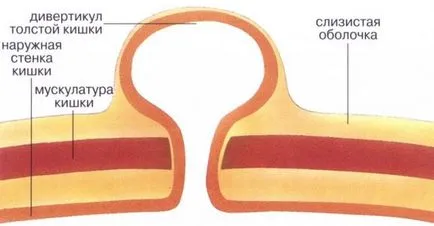 Simptomele diverticuloza si tratamentul bolii diverticulara a colonului