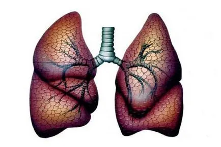 Diagnosticul și tratamentul metastazelor în plămâni