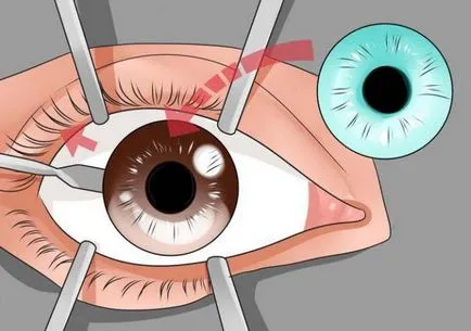 Какво операция се провежда от промяна на цвета на очите