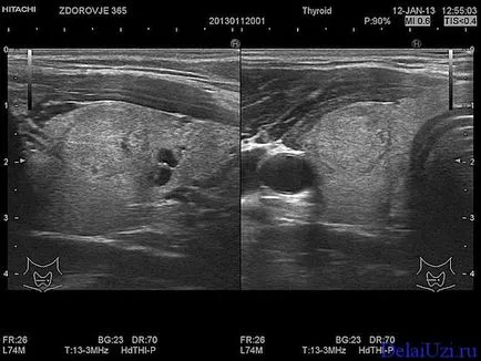 Metoda de Cancer Diaignostika Uzi arata ca o tumoare la ficat pe Uzi