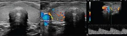 Ecografie Doppler a glandei tiroide - diagnosticarea bolii organism