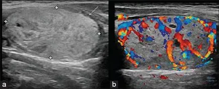 Ecografie Doppler a glandei tiroide - diagnosticarea bolii organism