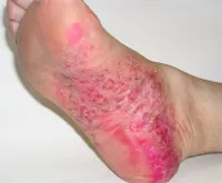 Exudatív psoriasis - okai, tünetei, diagnózisa és kezelése