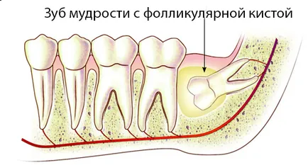 Chisturile foliculare dinți și tratarea acestora