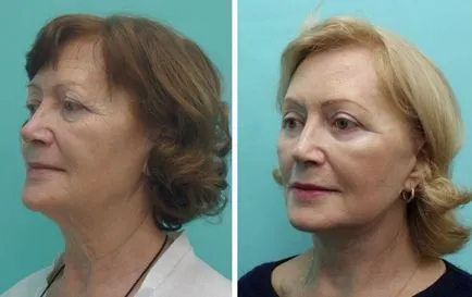 fata Faceliftul la Moscova, la Clinica platinental