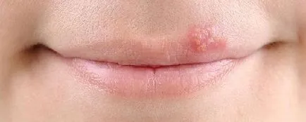 Herpes az ajkak gyors kezelést otthon