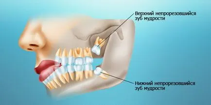 Когато се зъб мъдрост се търси отговор тук!