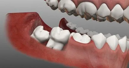 Когато се зъб мъдрост се търси отговор тук!