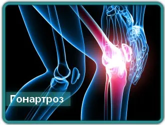 Osteoartrita (artroza genunchiului) Clinic de tratament complicații