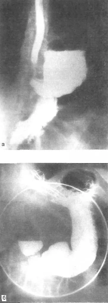 Hiatus sérv és reflux oesophagitis