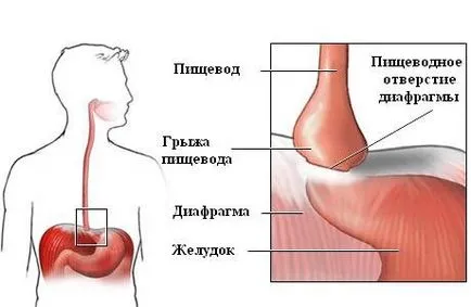 simptome hernie hiatala, tratament, intervenție chirurgicală