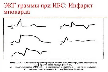 simptome CHD angină pectorală, diagnostic și tratament