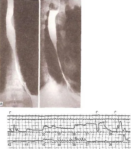 Hiatus sérv és reflux oesophagitis