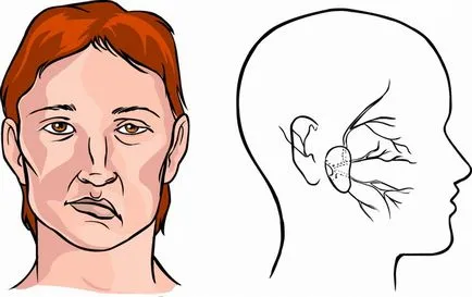 Ischemica accident vascular cerebral prognostic pentru viață, cum să mențină sănătatea