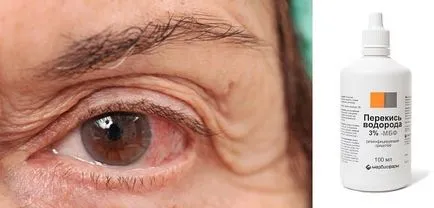 водороден прекис попадне в очите ви, които правят прости и бързи рецепти за лечение на zdravoline