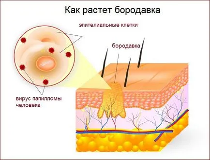 Как за лечение на брадавици по тялото от основните методи