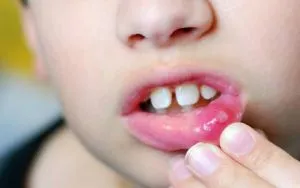 Hogyan kell alkalmazni a egy stomatitis Vinylinum használati utasítás, vélemények