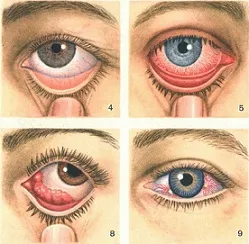 Капки от konjuktivita - ефективно лечение на заболявания на окото