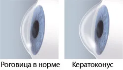 Keratoconus kezelése és a működési költségek